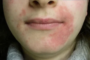Dermatite e emoçoes